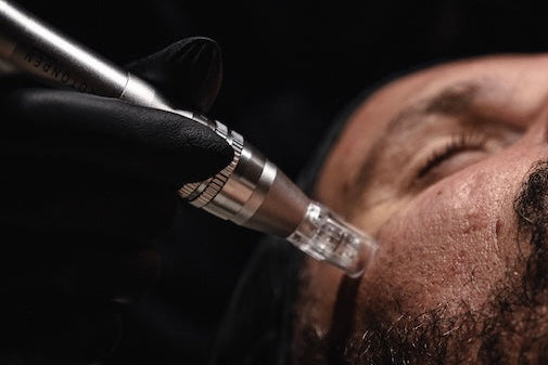 Mr. Adam Microneedling Treatment